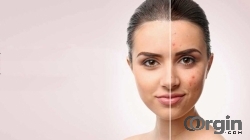 Acne Scar Treatment In Delhi- Cosmetic Dermatology India