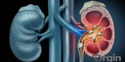 Polycystic kidney disease treatment in Coimbatore