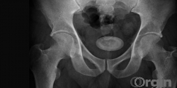 Bladder Stone: Causes, Symptoms, Diagnosis and Treatment