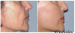 Rediscover Youthful Beauty with Face Lift Surgery in Delhi 
